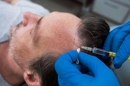 Hair Transplantation Procedure 