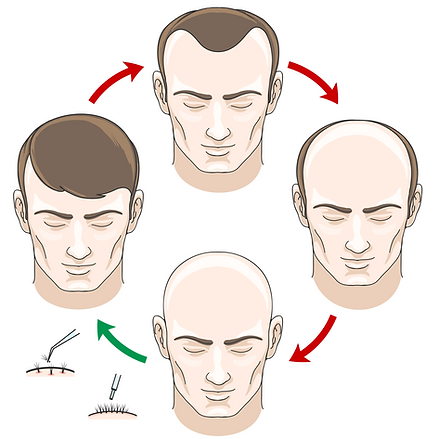 Journey of Hair Transplantation