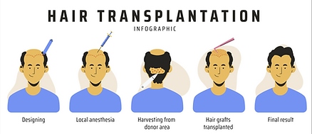 FUE Hair Transplant Procedure