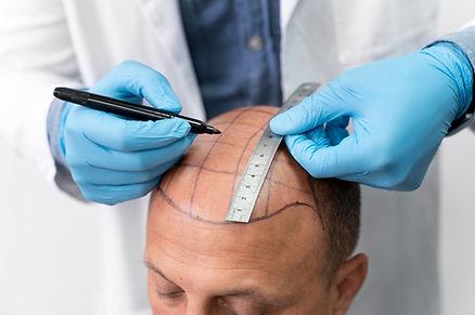 Hair Transplantation Procedure