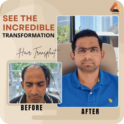 Hair Transplant Transformation Before and After