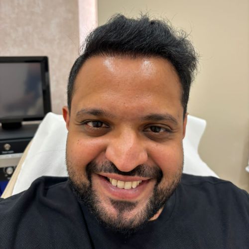 Roshan Sheety 6 months After Hair Transplant