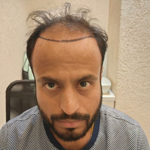 Ketan Tilve Before Hair Transplant