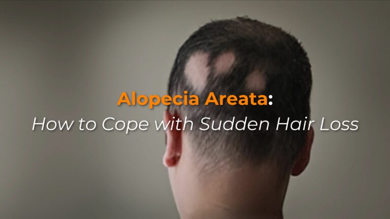 Alopecia Areata: How to Cope with Sudden Hair Loss