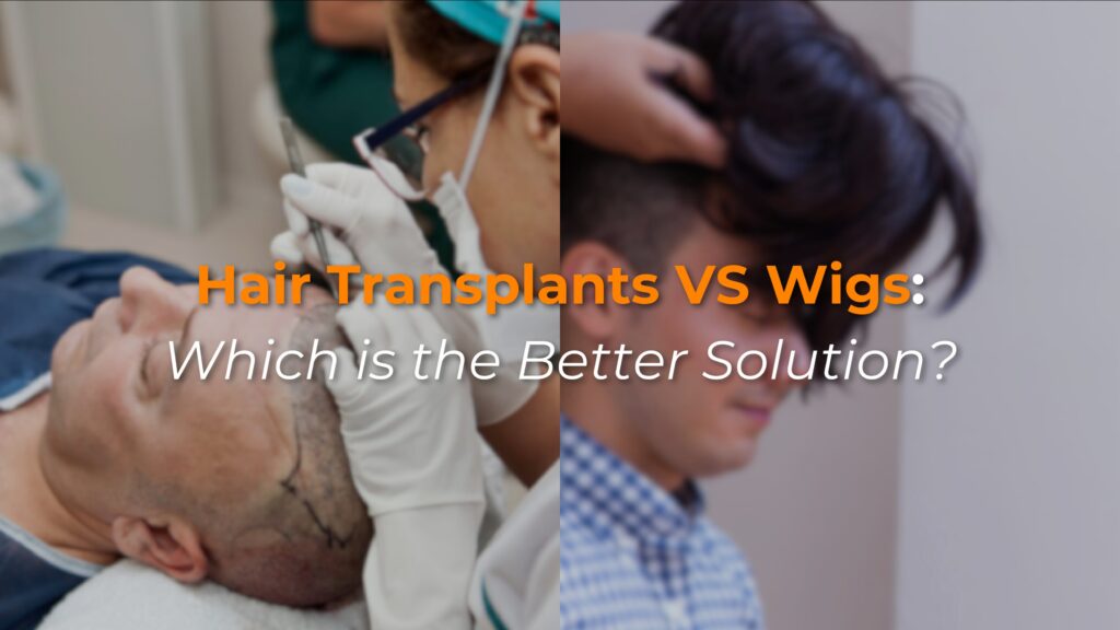 Hair Transplants vs. Wigs: Which is the Better Solution?
