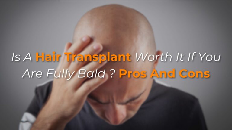 Is a Hair Transplant Worth It If You Are Fully Bald? Pros and Cons