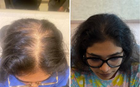 Meghal Shah — Hair transplant before and after at Assure Clinic