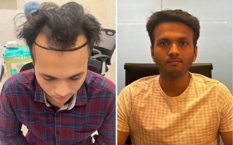 Mitansh Mandani — Hair transplant before and after at Assure Clinic