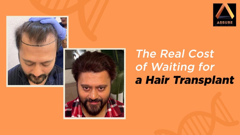 The Real Cost of Waiting for a Hair Transplant