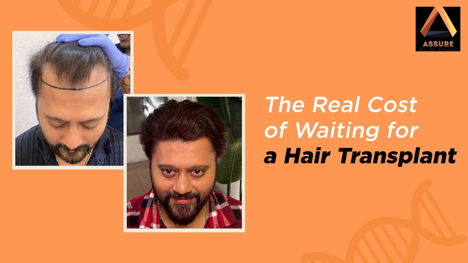 The Real Cost of Waiting for a Hair Transplant