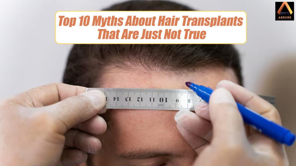 Top 10 Myths About Hair Transplants That Are Just Not True