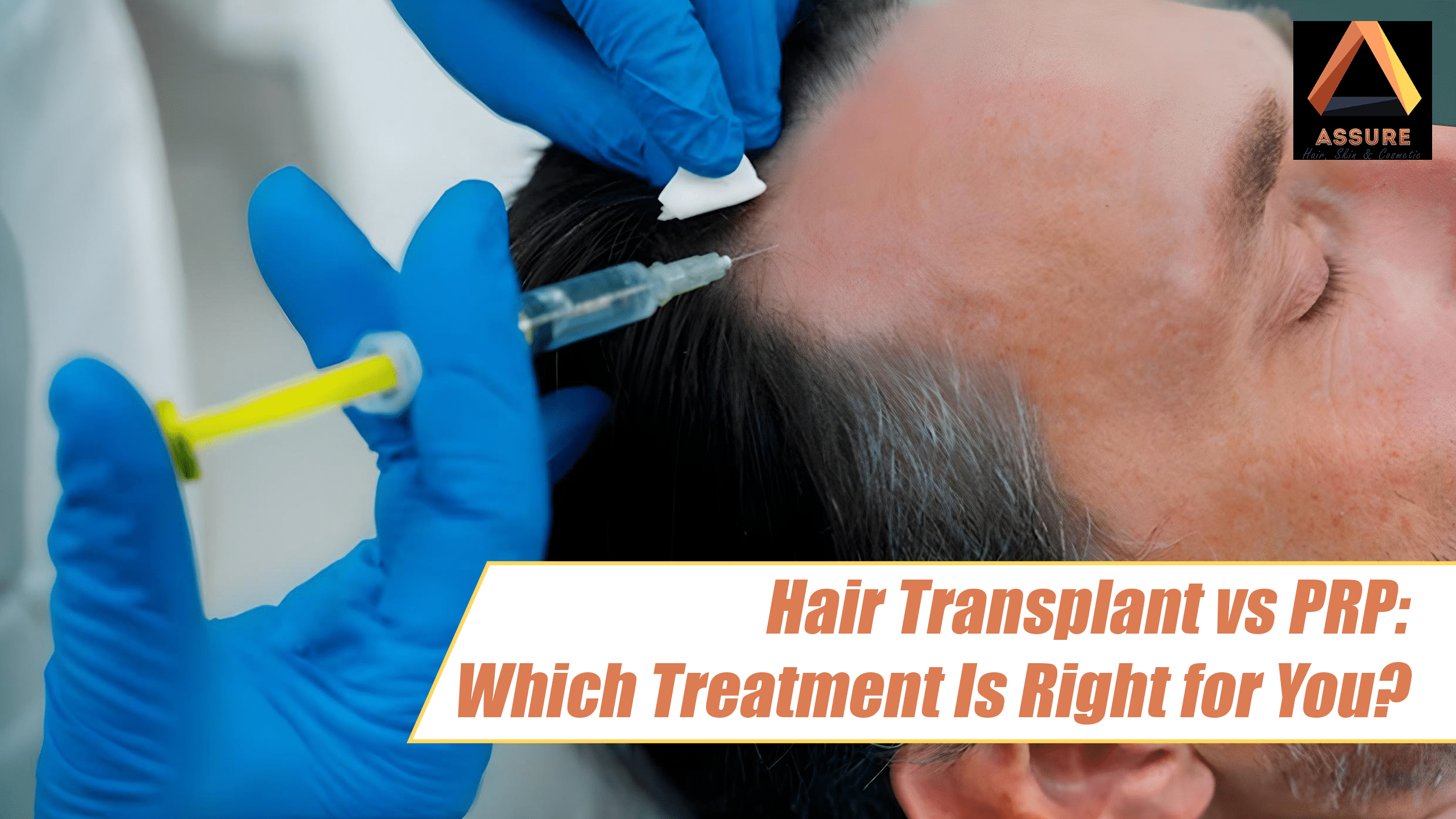 Hair Transplant vs PRP: Which Treatment Is Right for You?