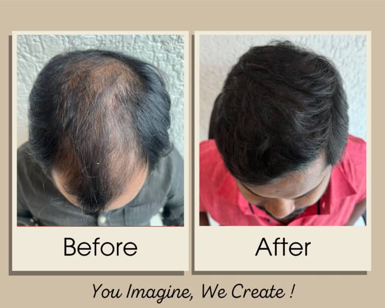 Hair transplant before and after result — Grade 4 at Assure Clinic