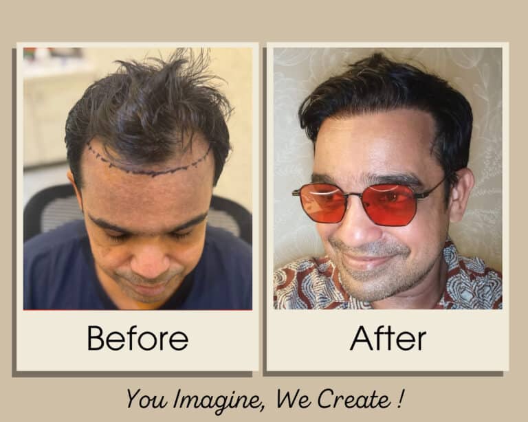 Hair transplant before and after result — Grade 3A at Assure Clinic