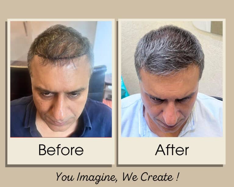 Hair transplant before and after result — Grade 3 at Assure Clinic