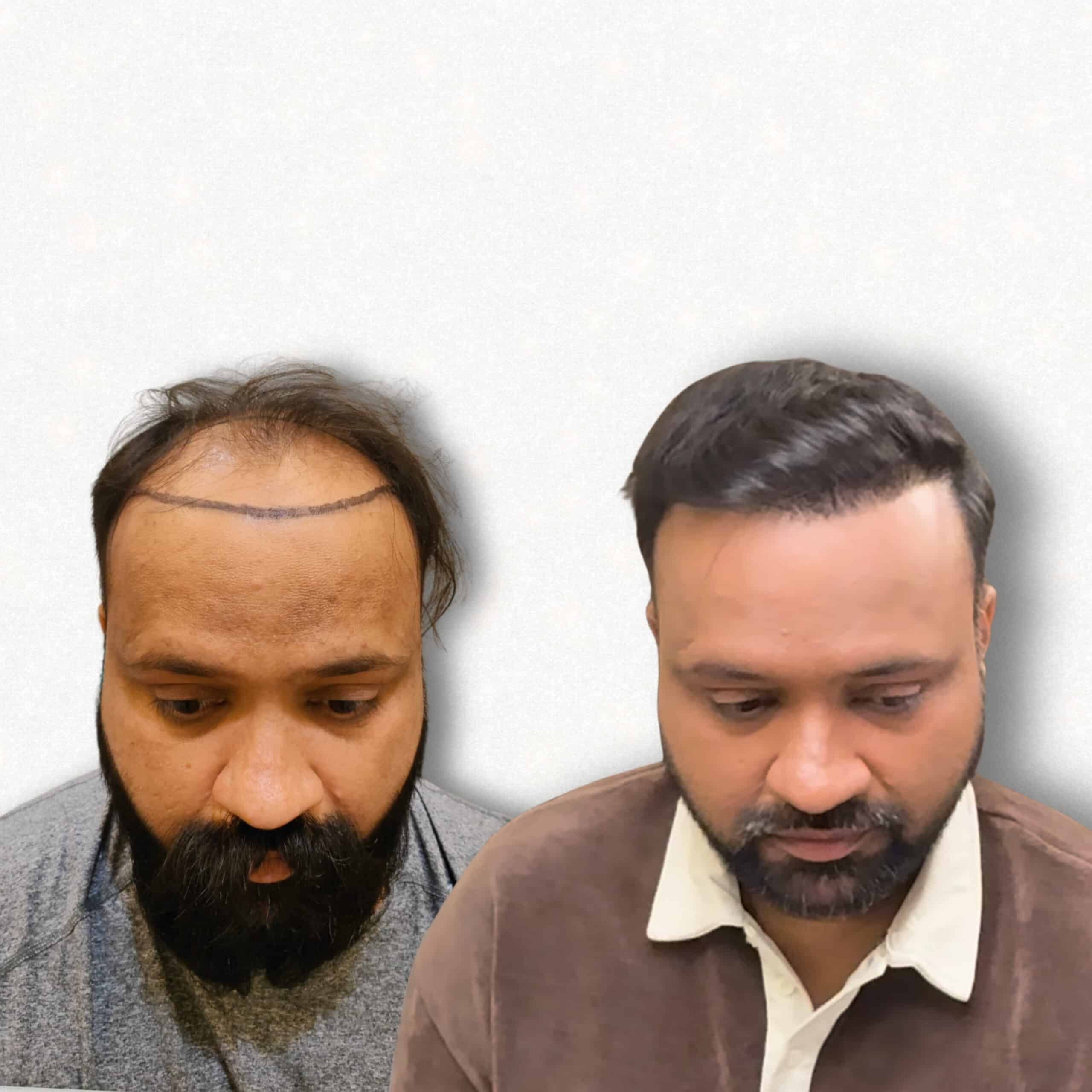 Hair transplant before and after result — real patient at Assure Clinic