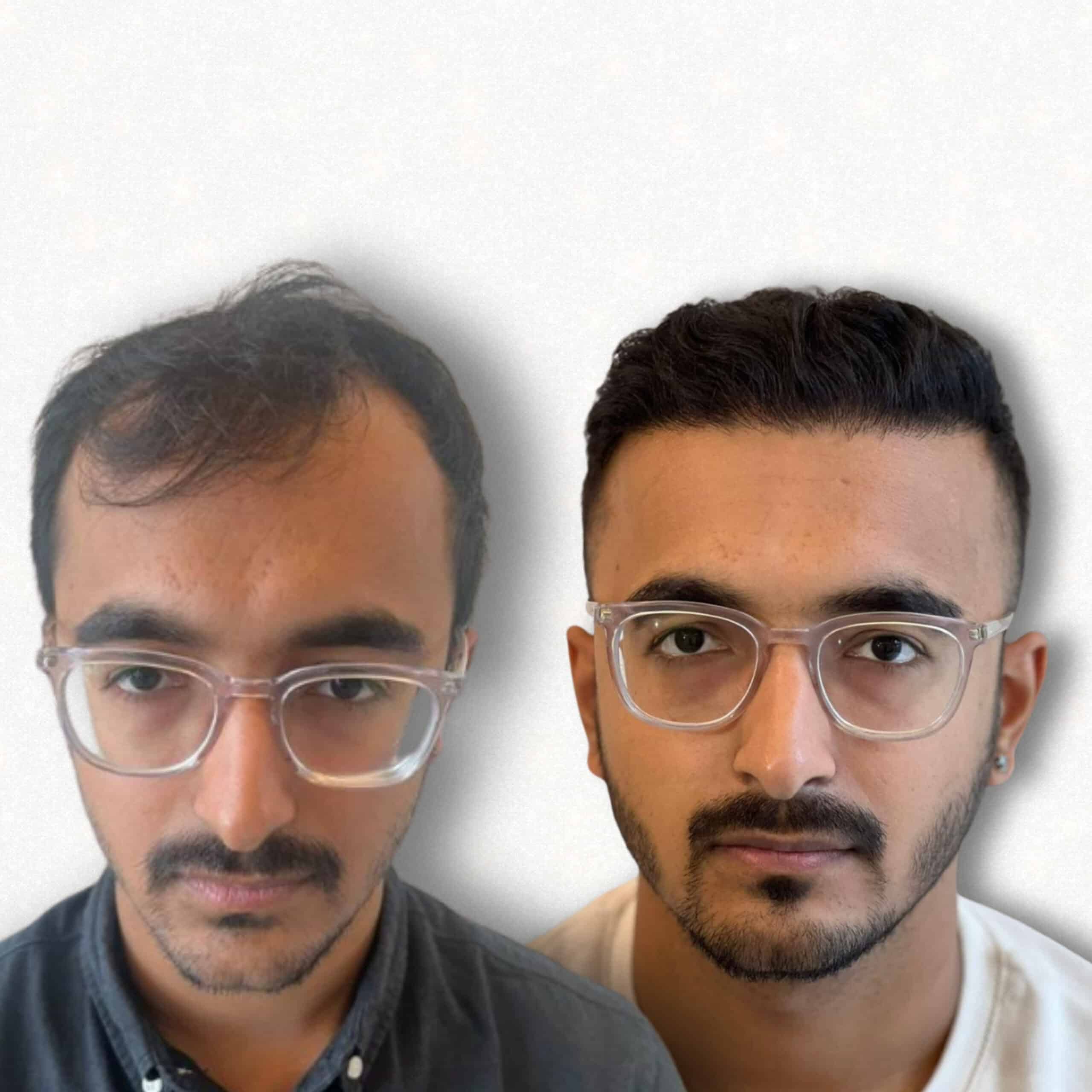 Hair transplant before and after result at Assure Clinic Raipur