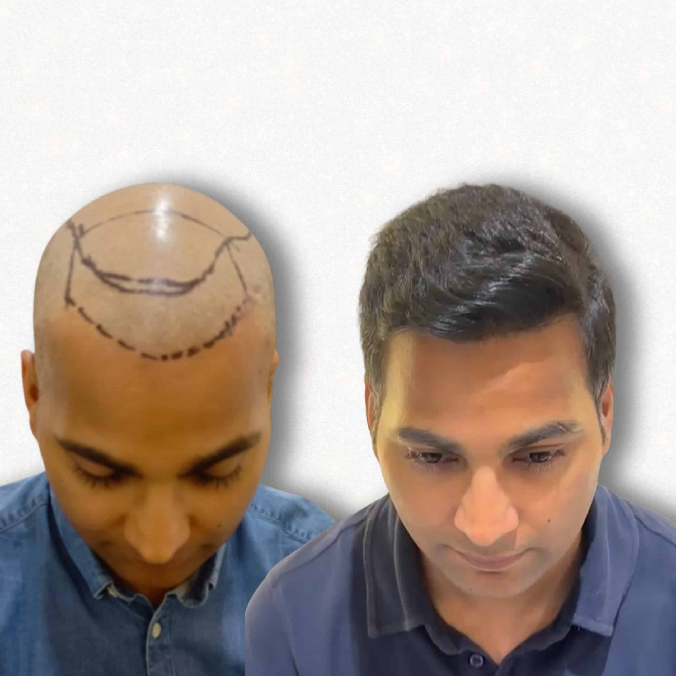 Hair transplant before and after result at Assure Clinic Indore