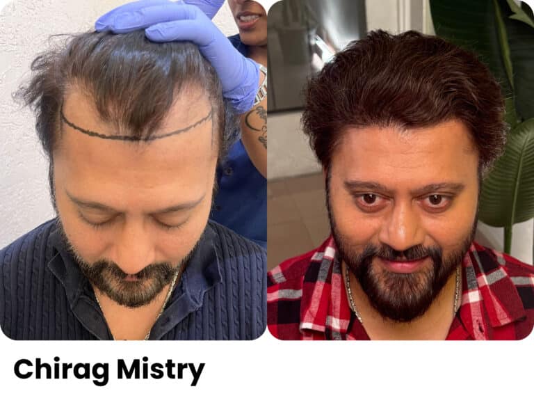 Chirag Mistry — Hair transplant before and after at Assure Clinic