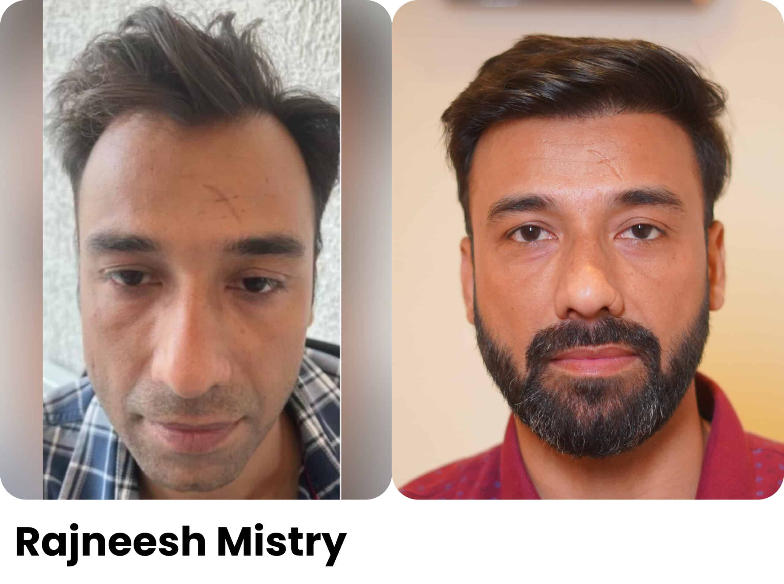 Rajneesh Mistri hair transplant before and after