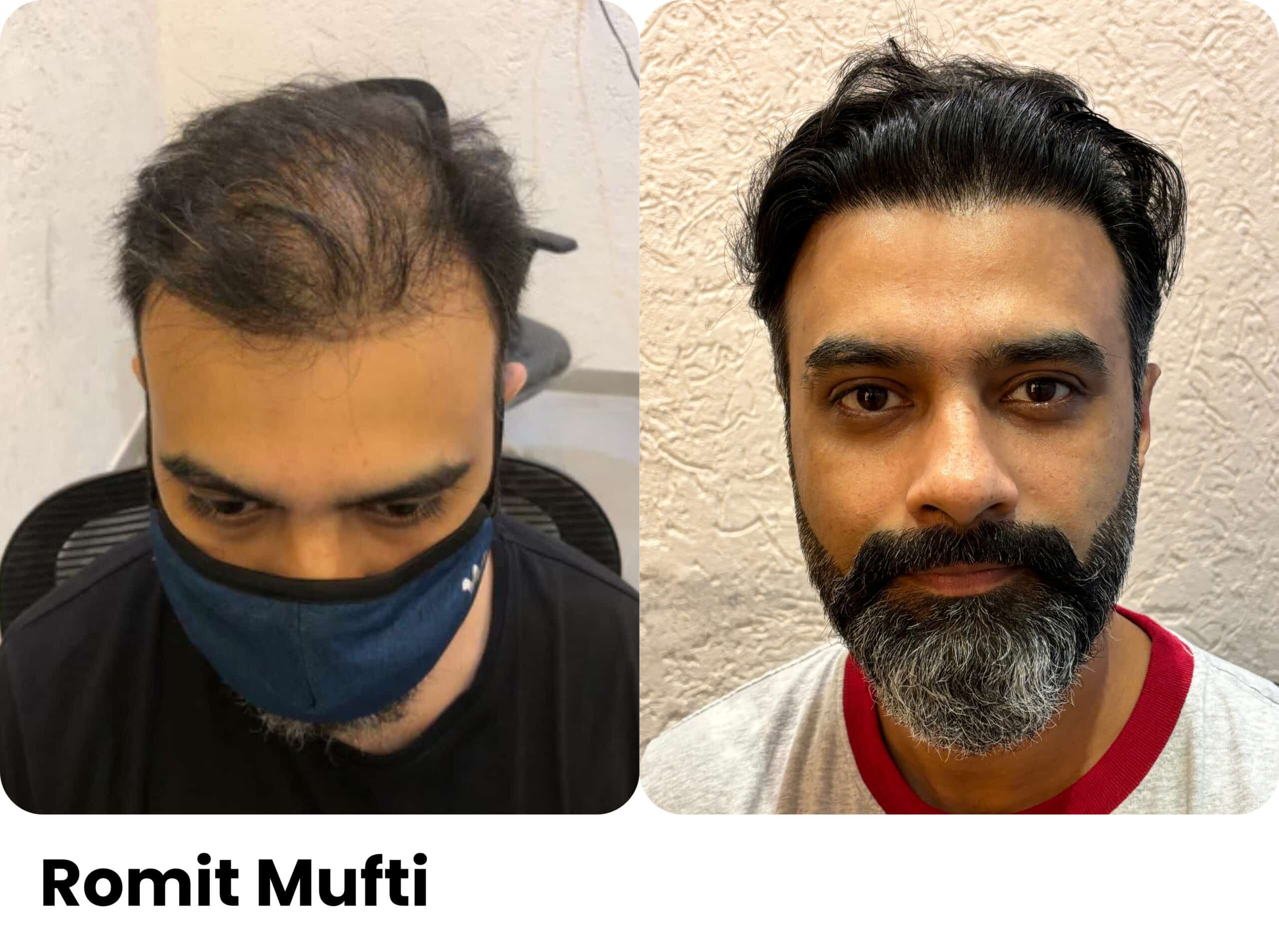 Romit Mufti hair transplant before and after