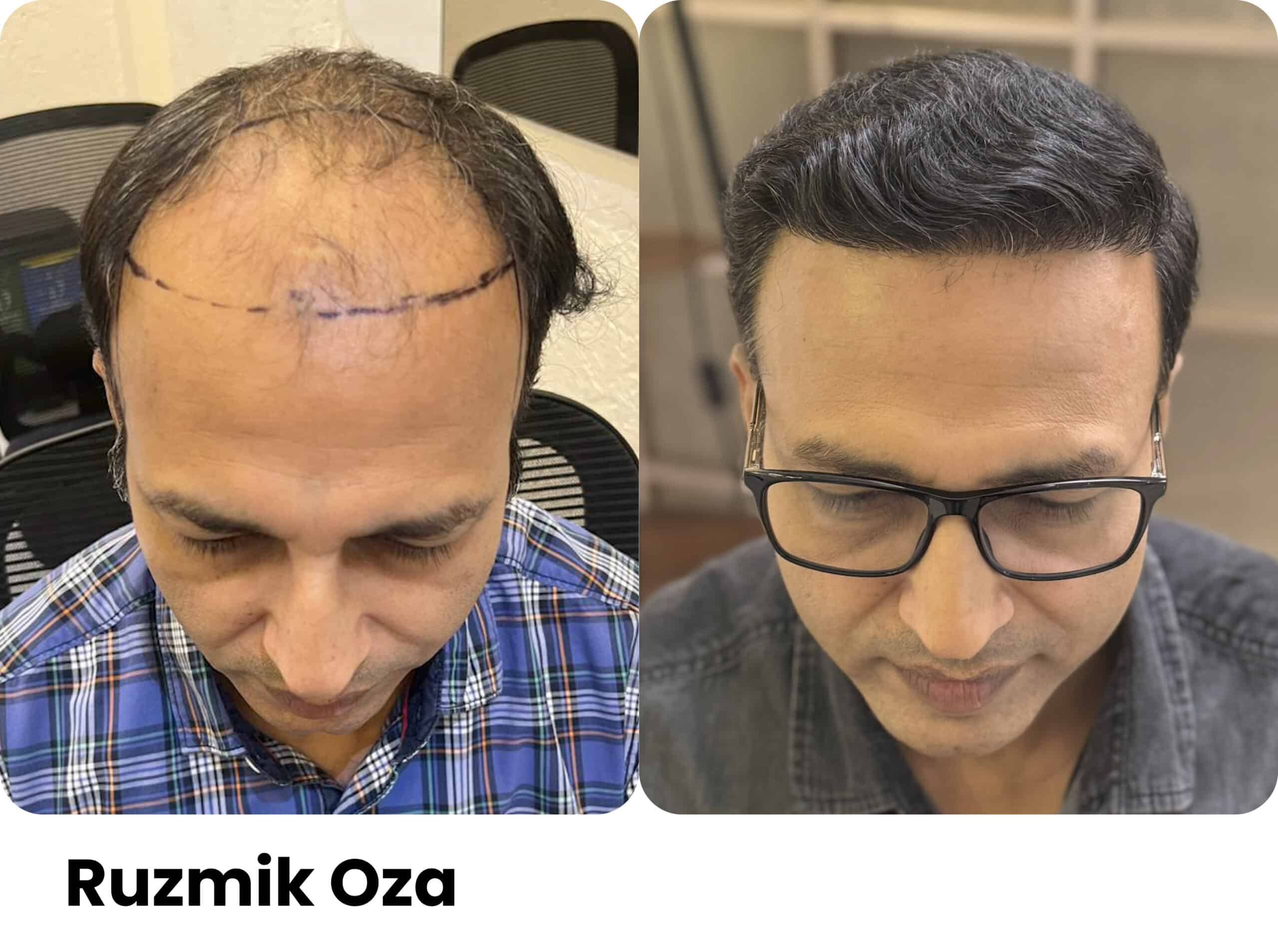 Rusmik Oza hair transplant before and after