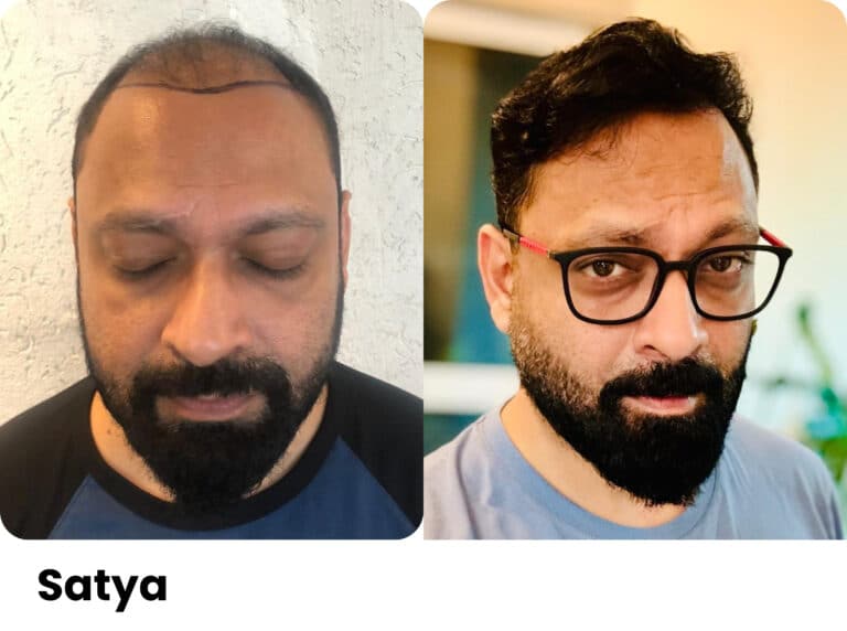 Satya Ottur — Hair transplant before and after at Assure Clinic