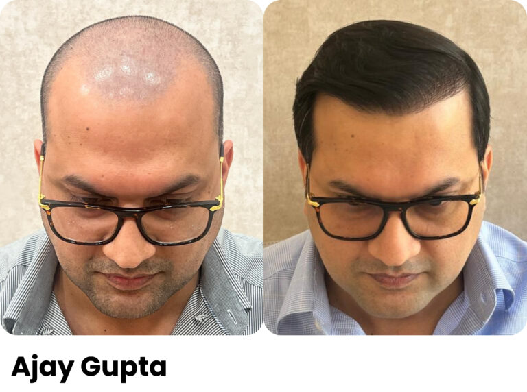Ajay Gupta — Hair transplant before and after at Assure Clinic