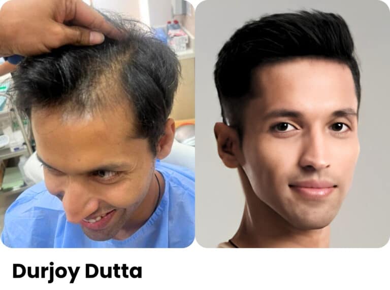 Durjoy Datta — Hair transplant before and after at Assure Clinic
