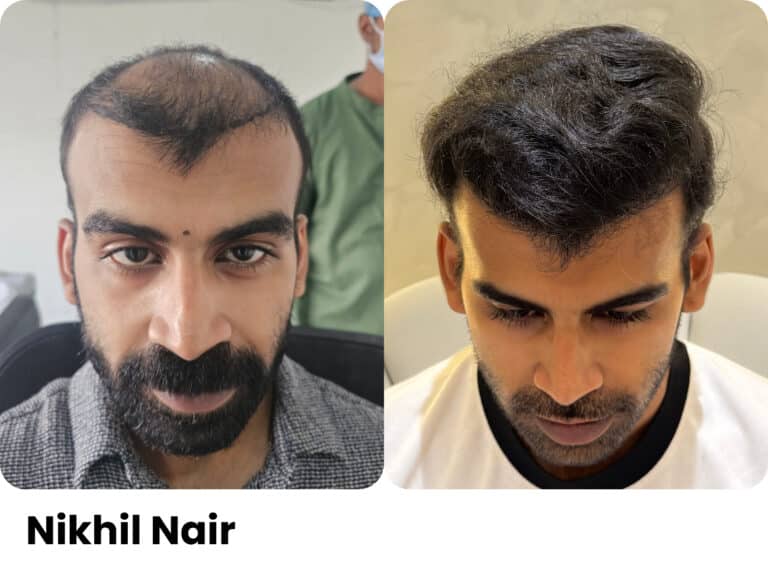 Nikhil Nair — Hair transplant before and after at Assure Clinic