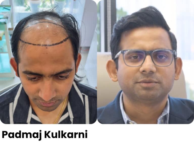 Padmaj Kulkarni — Hair transplant before and after at Assure Clinic