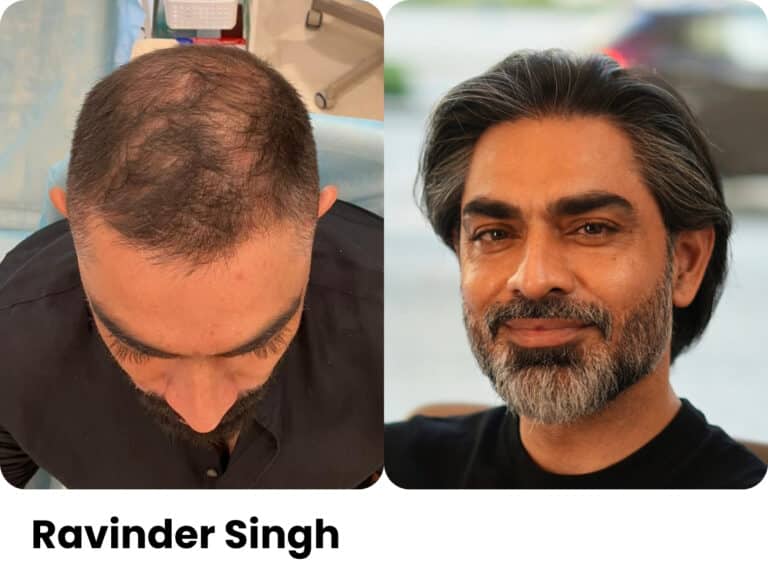 Ravinder Singh — Hair transplant before and after at Assure Clinic