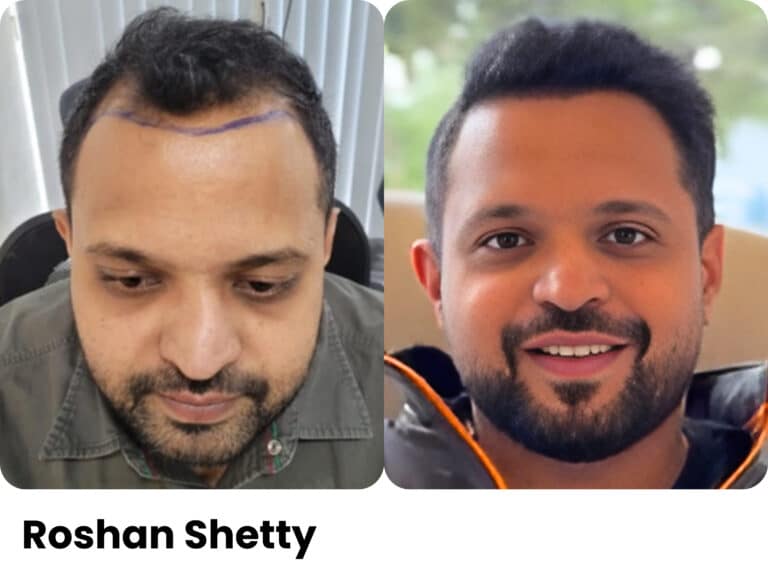 Roshan Shetty — Hair transplant before and after at Assure Clinic