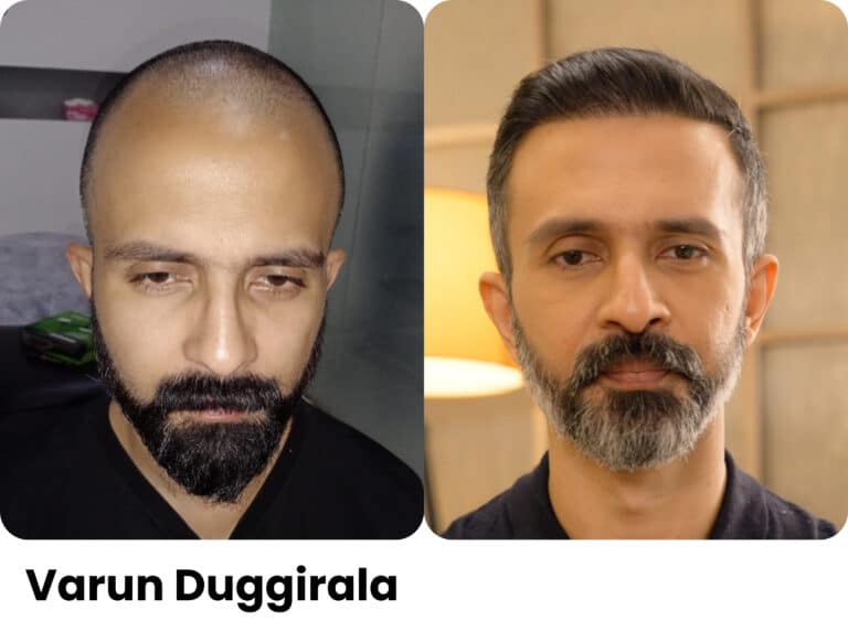Varun Duggirala — Hair transplant before and after at Assure Clinic