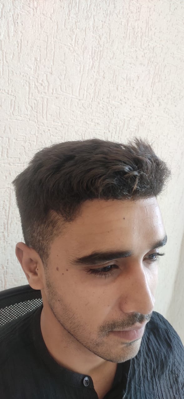 Miran Khan — Regrowth Begins — hair transplant at Assure Clinic