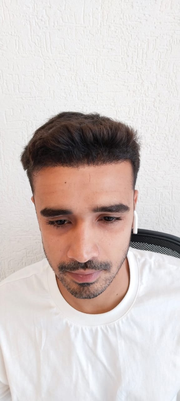 Hair transplant after 6 months &ndash; Miran Khan