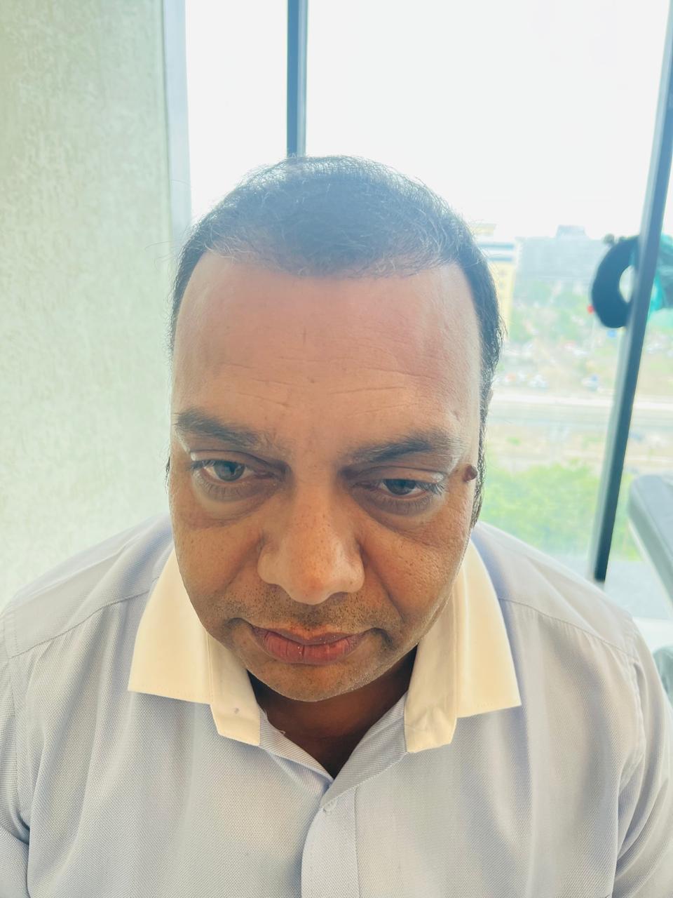 Sudhir Vyas — Early Days — hair transplant at Assure Clinic