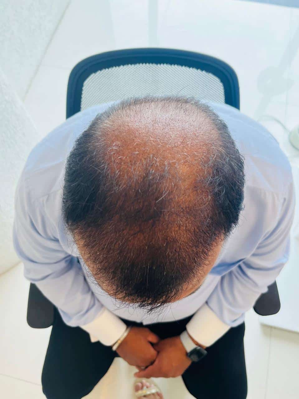Sudhir Vyas — Early Days — hair transplant at Assure Clinic