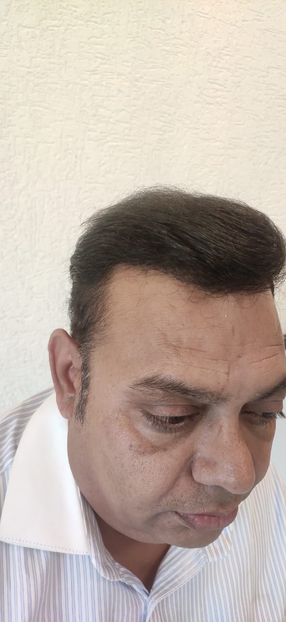 Hair transplant after 6 months &ndash; Sudhir Vyas