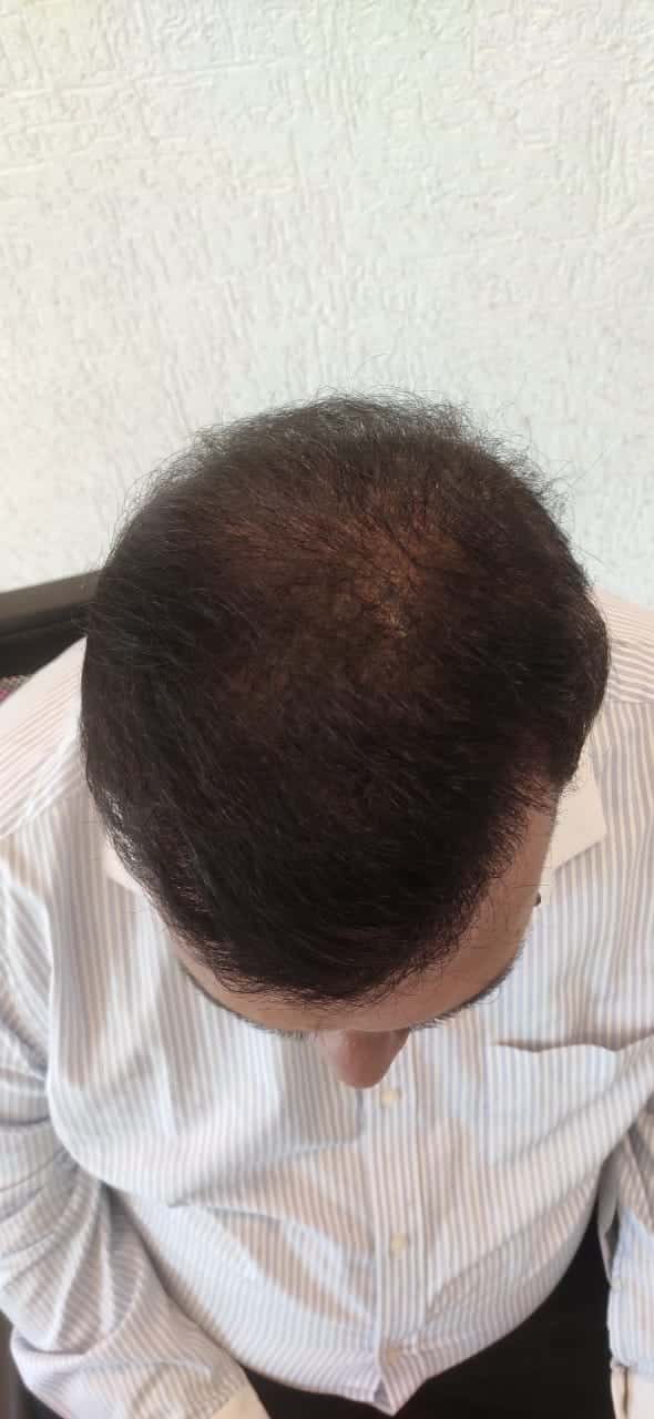 Sudhir Vyas after hair transplant