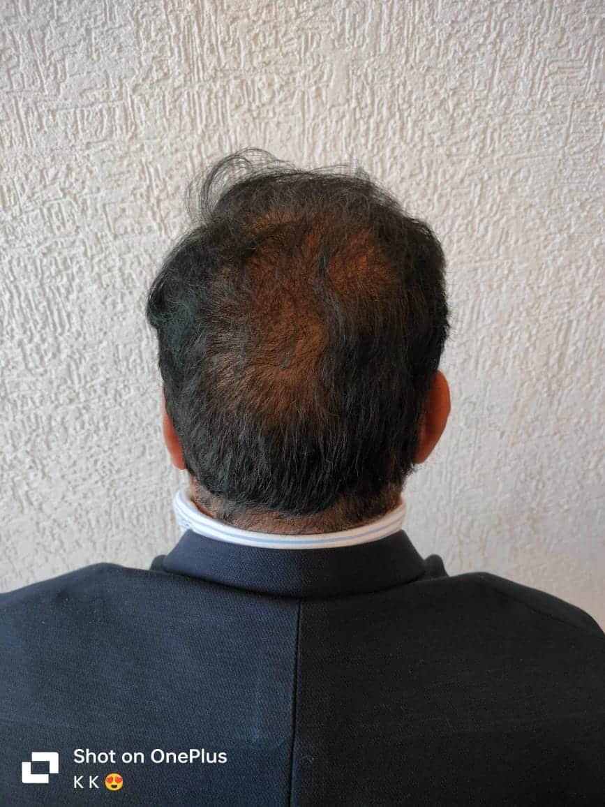 Sudhir Vyas before hair transplant