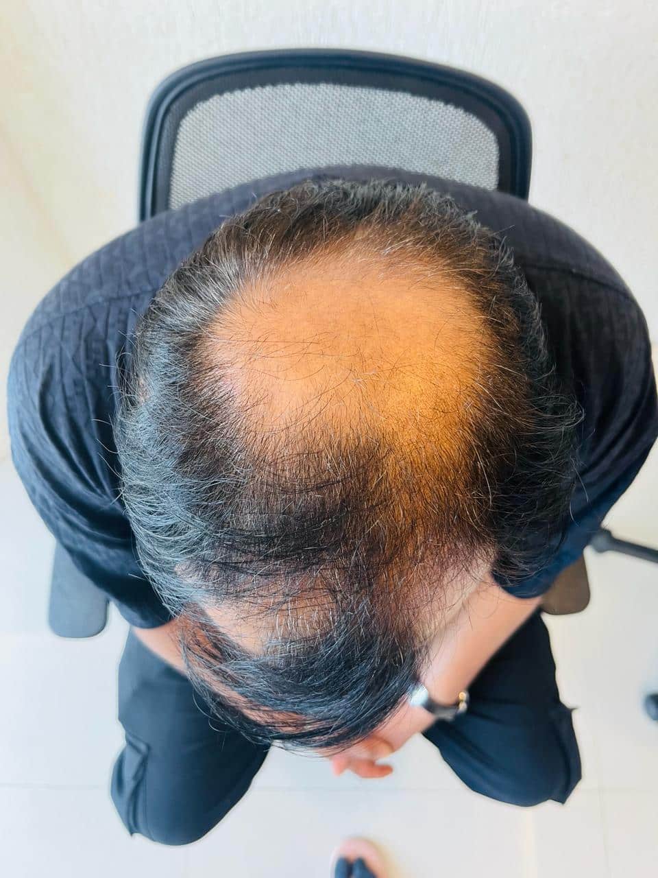 Sudhir Vyas before hair transplant
