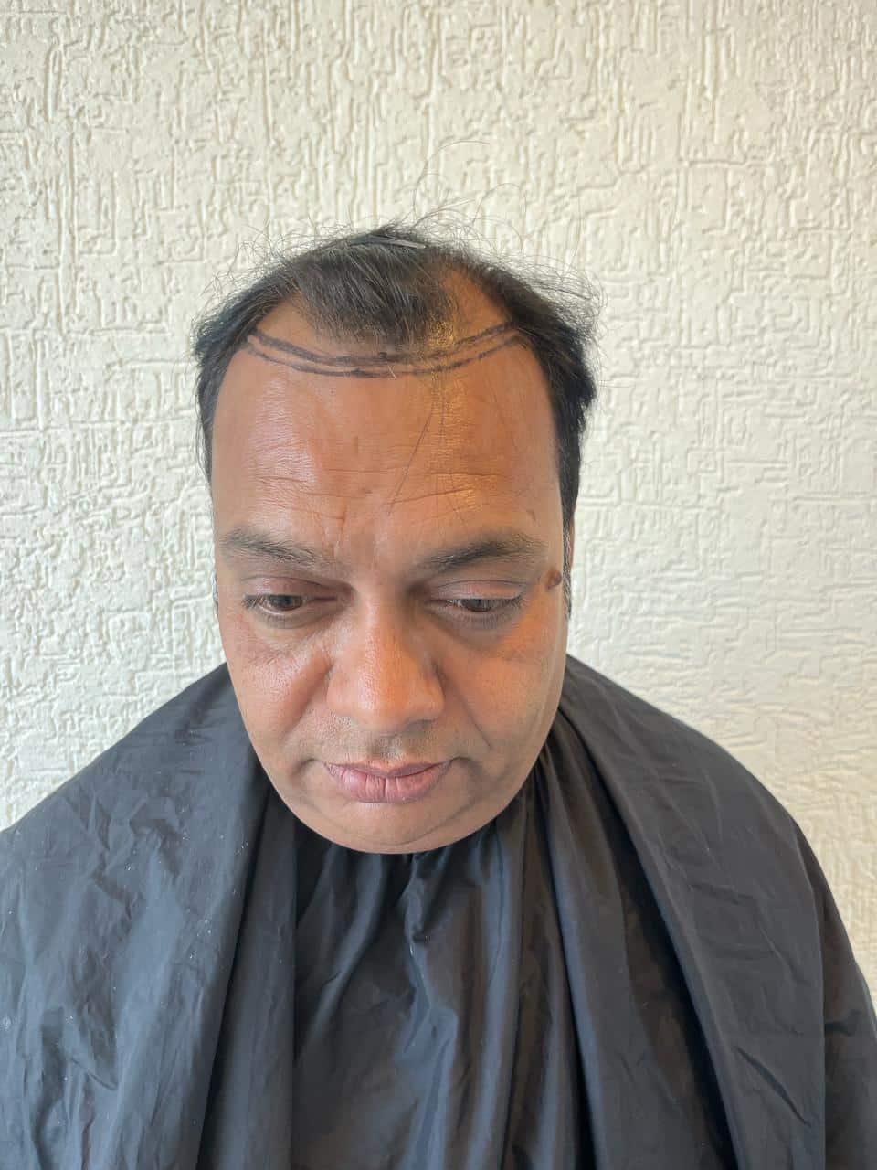 Sudhir Vyas — Hairline Design — hair transplant at Assure Clinic