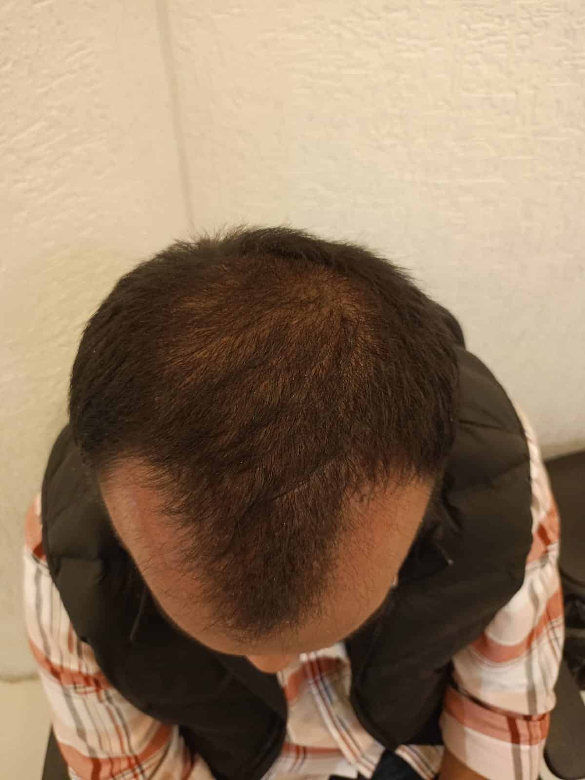Chayan — The Shedding Phase — hair transplant at Assure Clinic