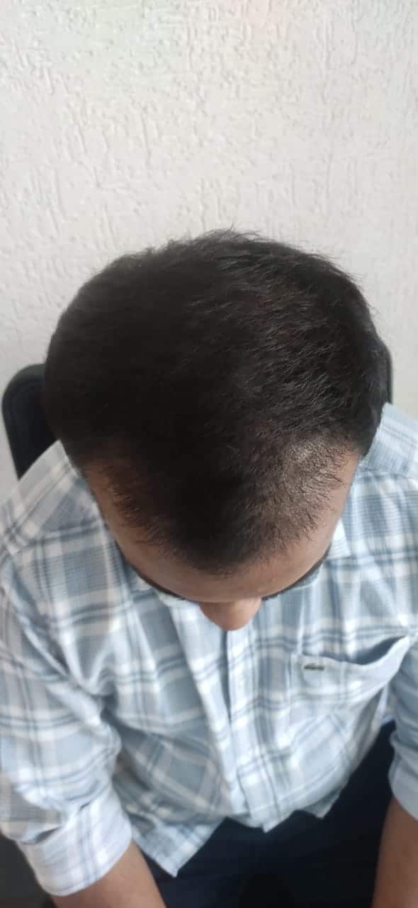 Hair transplant month 3 — documented Assure Clinic patient