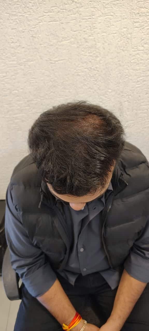 Hair transplant month 8 — documented Assure Clinic patient