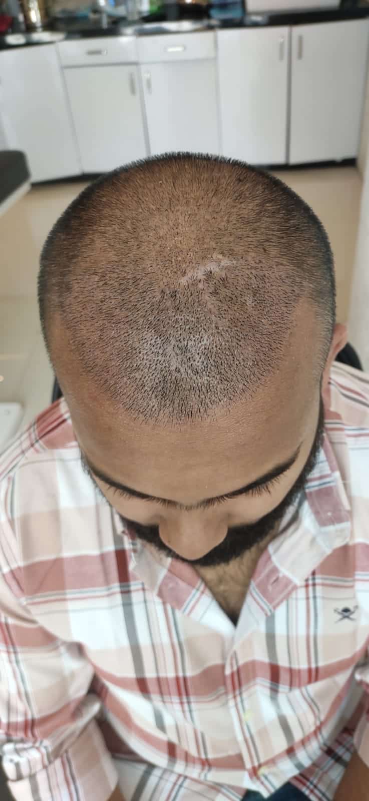 Chayan — Grafts Settling — hair transplant at Assure Clinic