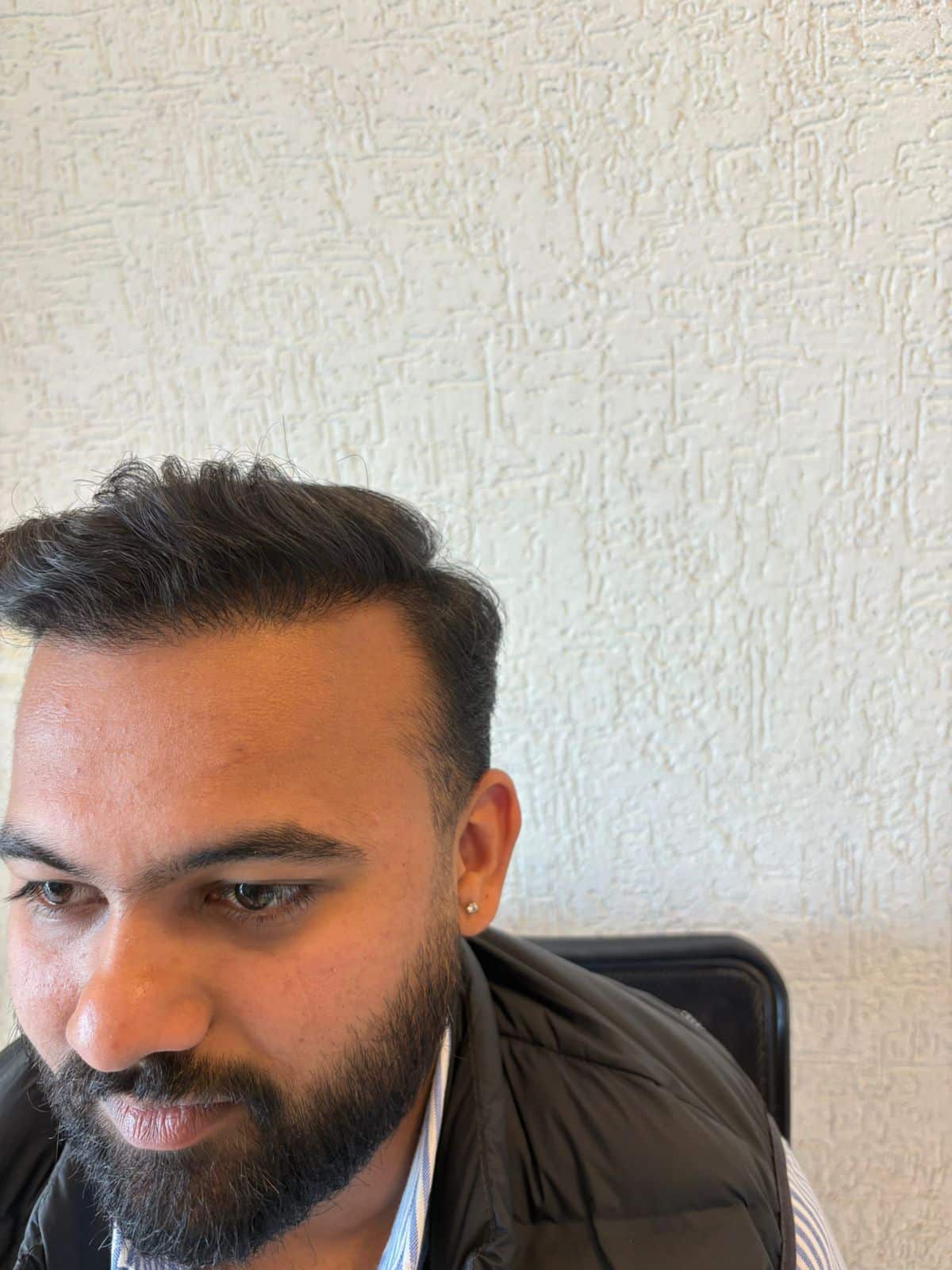 Chayan before hair transplant
