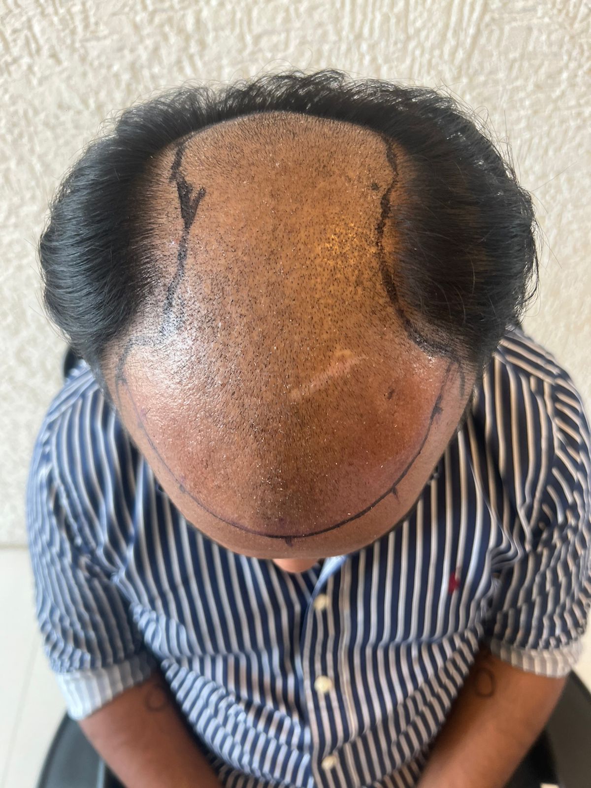 Chayan — Hairline Design — hair transplant at Assure Clinic