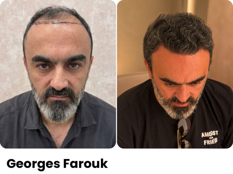 Georges Farouk — Hair transplant before and after at Assure Clinic
